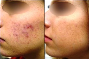 tratamento-acne-laser-co2-300x200